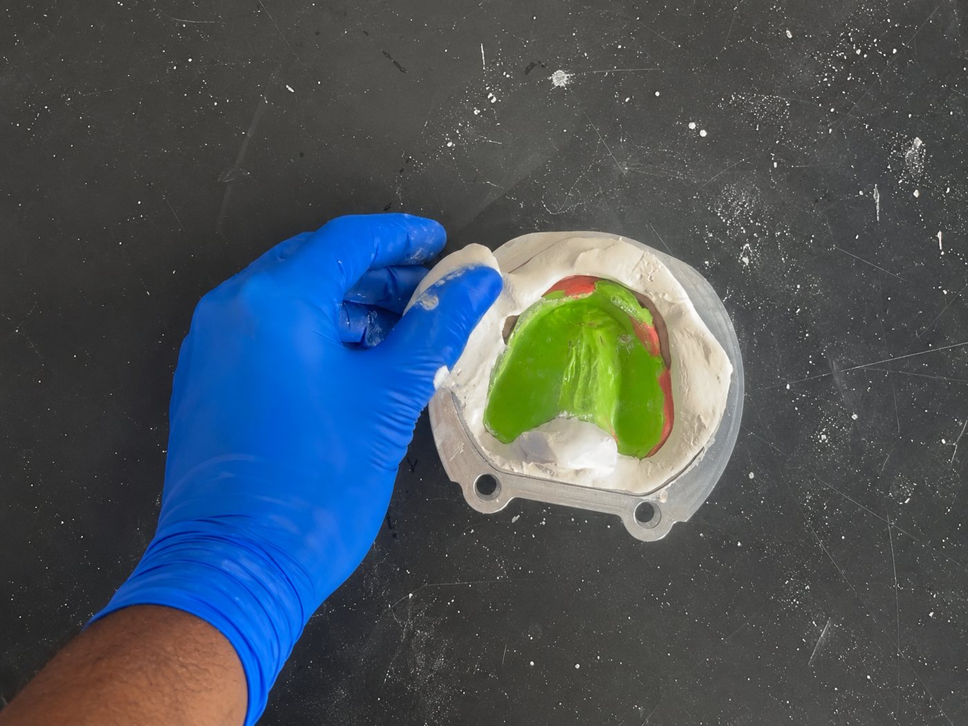 Gloved hand seating a green-protected prosthetic into plaster in the flask